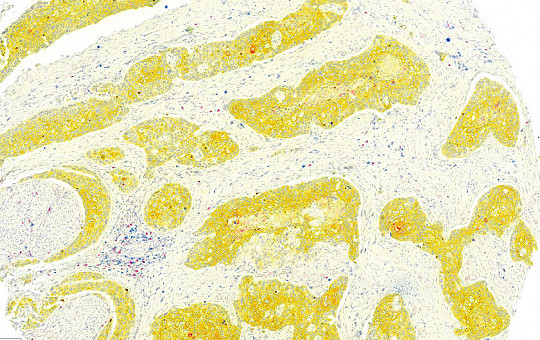Esophagus Squamous Cell Carcinoma: CD4, CD8, PanCK 5x. Biomax TMA.